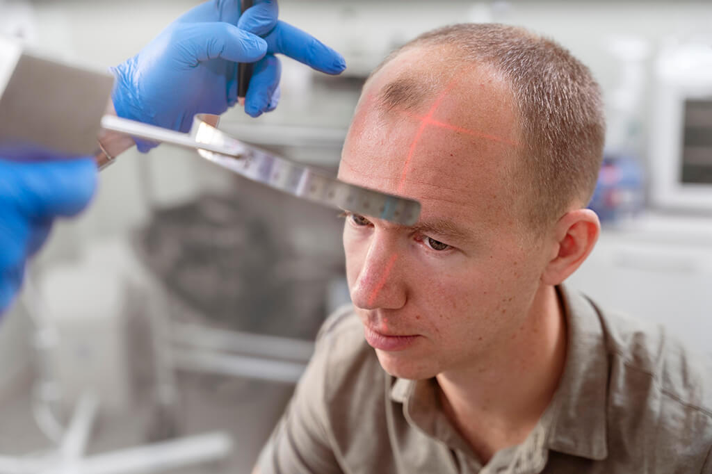 Hair Transplant in Turkey