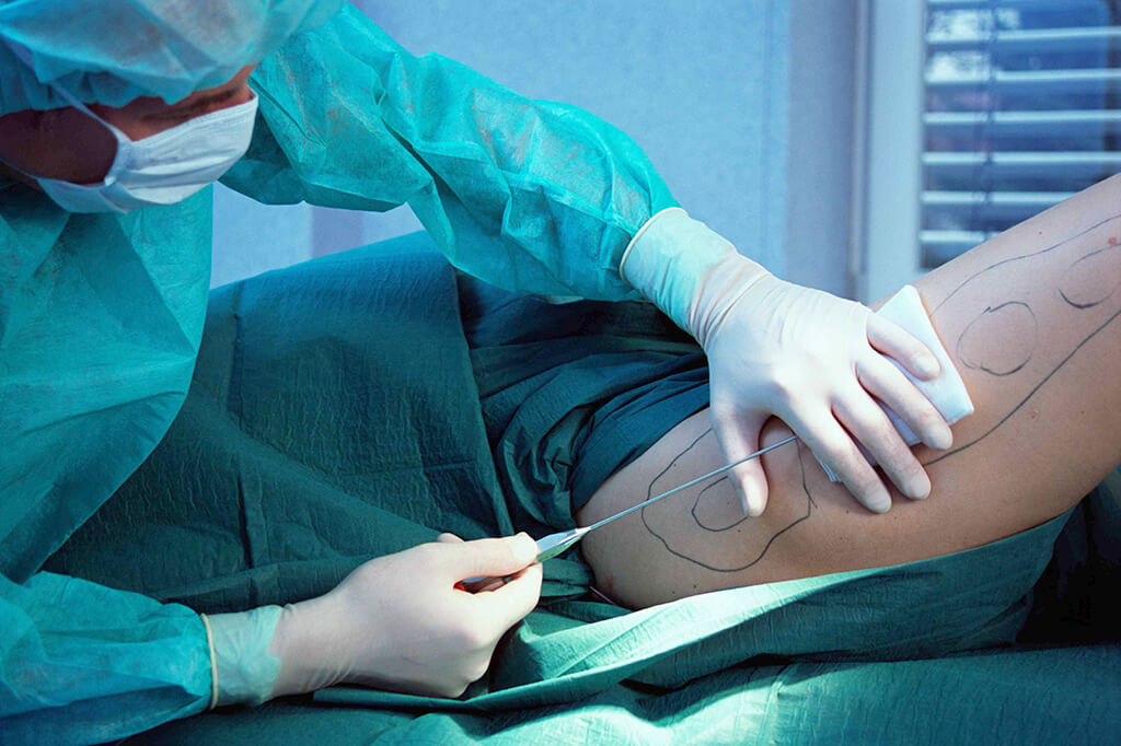 Liposuction in Turkey