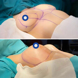 Breast Implants Before and After
