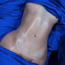 Liposuction Procedure in Turkey