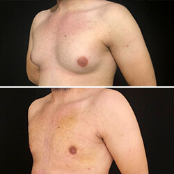 Gynecomastia Before and After in Turkey