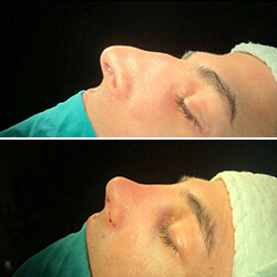 Nose Reshaping Result in Istanbul