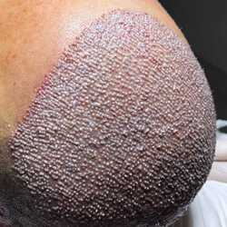 Sapphire Fue Hair Transplant Turkey